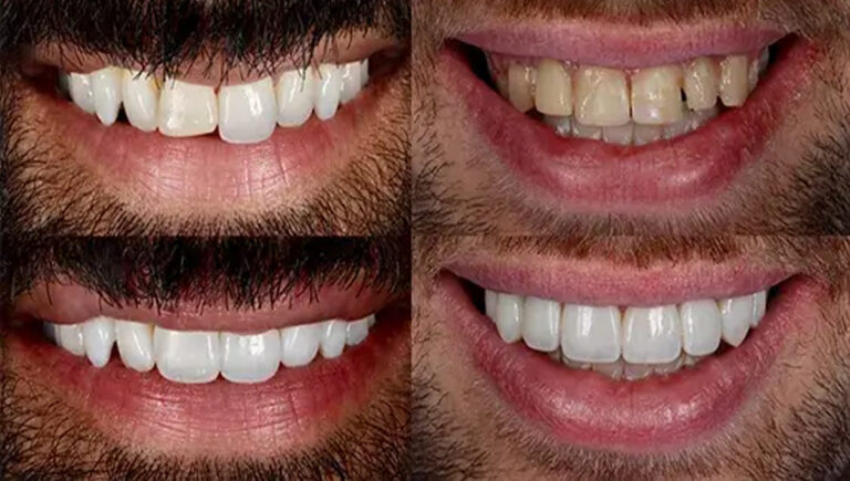 സര്‍ക്കാര്‍ ജോലികള്‍ക്ക് ഉന്തിയ പല്ല് ഇനി അയോഗ്യതയല്ല; മന്ത്രിസഭാ തീരുമാനം