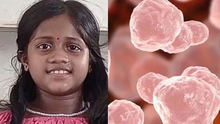 താമരശ്ശേരിയിലെ ഒൻപതുവയസുകാരിയുടെ മരണം അമീബിക് മസ്തിഷ്കജ്വരമല്ലെന്ന് പോസ്റ്റ്മോർട്ടം റിപ്പോർട്ട്