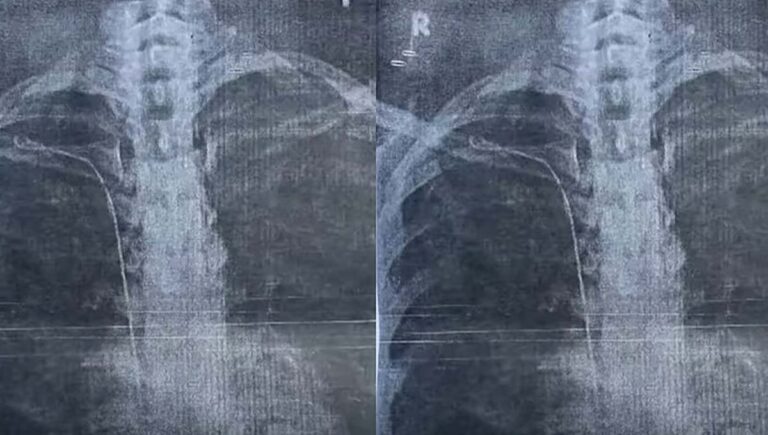 തിരുവനന്തപുരം ജനറല്‍ ആശുപത്രിയില്‍ വീണ്ടും ചികിത്സാപിഴവ്; ശസ്ത്രക്രിയക്കിടെ നെഞ്ചില്‍ ട്യൂബ് കുടുങ്ങി