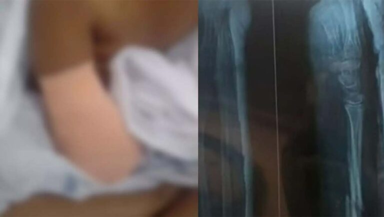 പാലക്കാട് ഒമ്പത് വയസുകാരിയുടെ കൈ മുറിച്ചുമാറ്റിയ സംഭവം; ചികിത്സാ പിഴവ് സമ്മതിച്ച് ജില്ലാ ആശുപത്രി