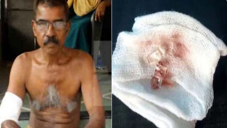 ചേർത്തല താലൂക്ക് ആശുപത്രിയിൽ ചില്ല് നീക്കാതെ മുറിവ് തുന്നിക്കെട്ടിയെന്ന് ആരോപണം