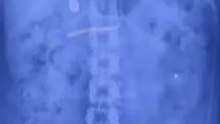 മലപ്പുറത്ത് കുഞ്ഞിനെ ലാളിക്കുന്നതിനിടെ സ്വര്‍ണമാല മോഷ്ടിച്ച് വിഴുങ്ങിയ യുവതി പിടിയില്‍